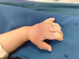 Nguy Cơ Bỏng Cho Trẻ Em 