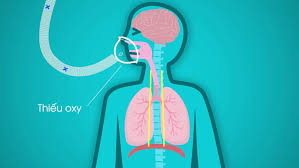 Đột Quỵ Khi Tắm: "Lưỡi Hái Tử Thần" Trong Nhà Tắm Và Cẩm Nang Phòng Ngừa Toàn Diện 4 Thiếu oxy lên não